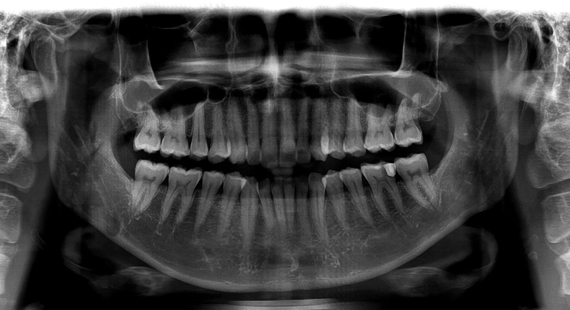 Aesthetic Porcelain Veneers Transformation